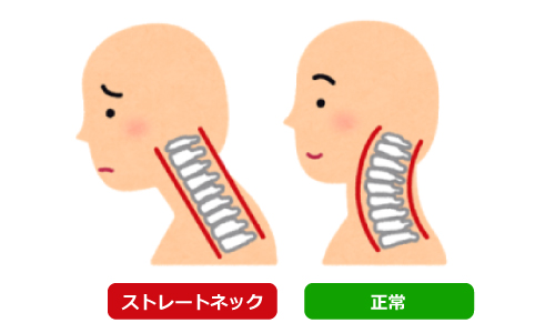 YOKONE3はストレートネックの人にもオススメ