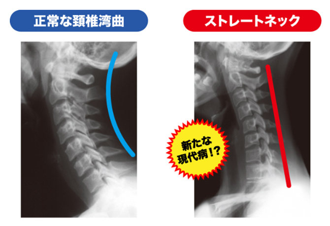 ストレートネックとは